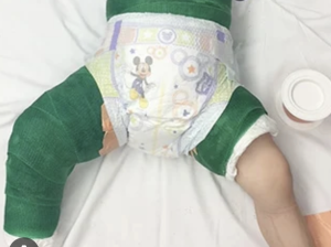 baby in green hip cast, incontinence helped by chiropractic care